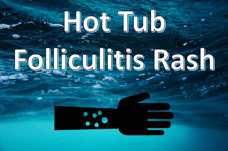 hot tub folliculitis rash
